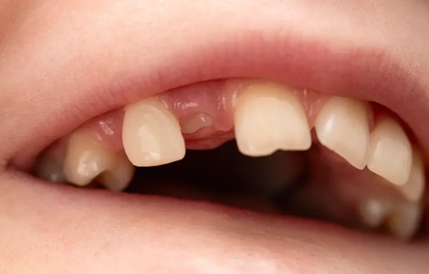 Broken Tooth at Gum Line: Can a Dentist Pull It & What to Expect
