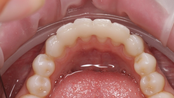 when to replace teeth retainer when to replace teeth retainer