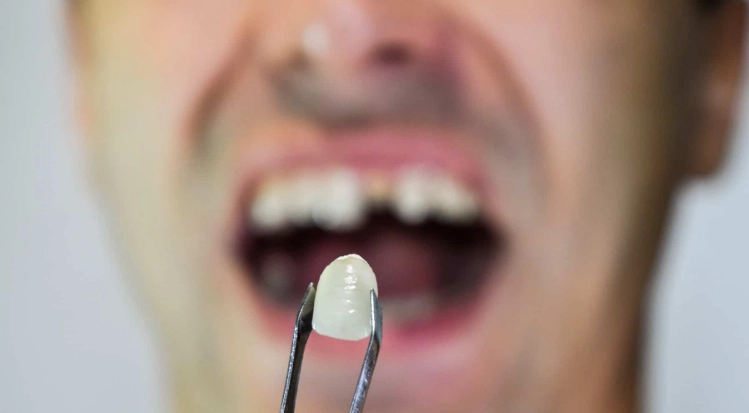 broken tooth at gum line extraction