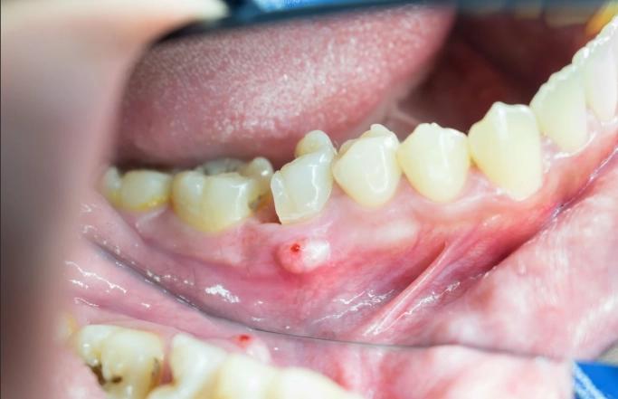 abscess drainage abscess drainage