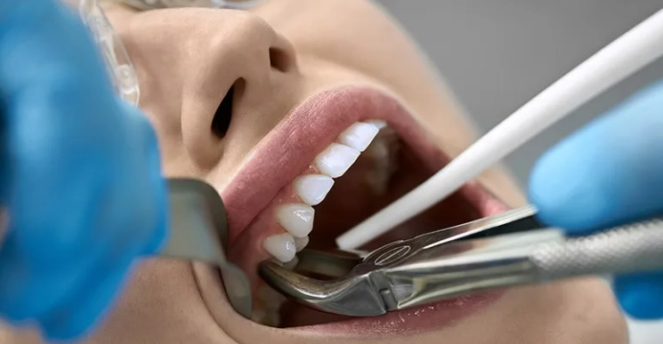 broken tooth at gum line extraction