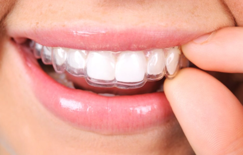 retainer replacement schedule retainer replacement schedule