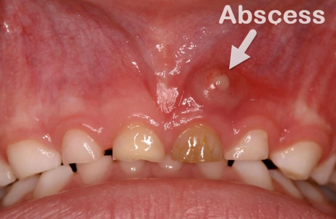 dental abscess symptoms dental abscess symptoms