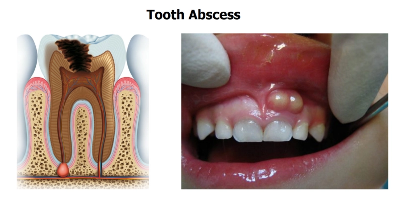 Dental Abscess: Complete Guide to Symptoms, Treatment, and Prevention