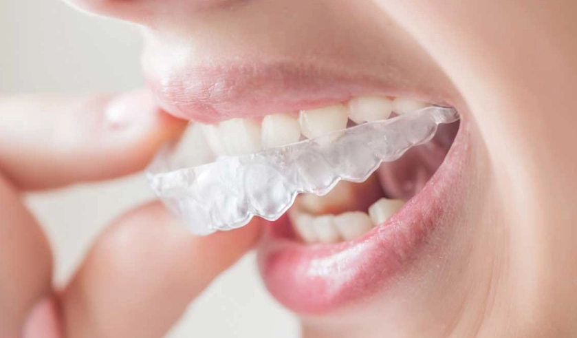 How Long Do Plastic Retainers Last? The Ultimate Lifespan Guide