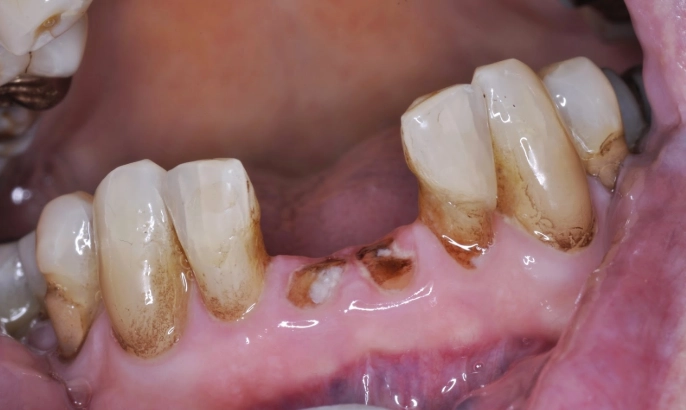 extraction of tooth broken at gum line