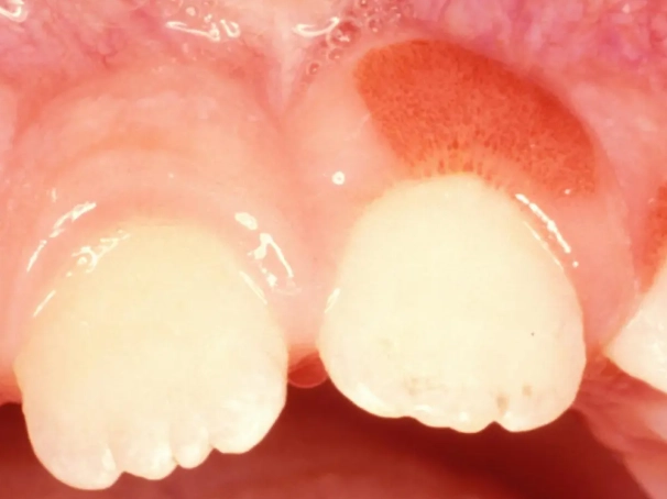 gum inflammation gum inflammation