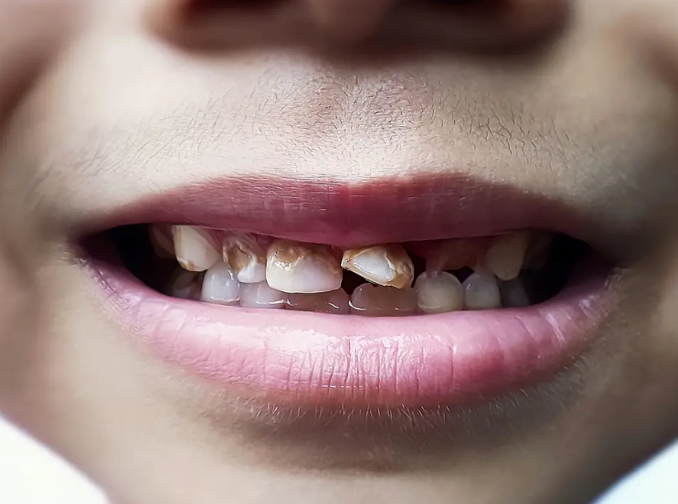 how to use coconut oil for teeth how to use coconut oil for teeth