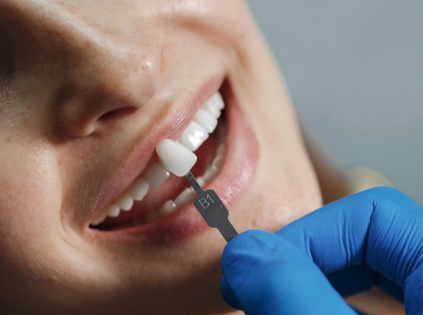 dental crown cement dental crown cement