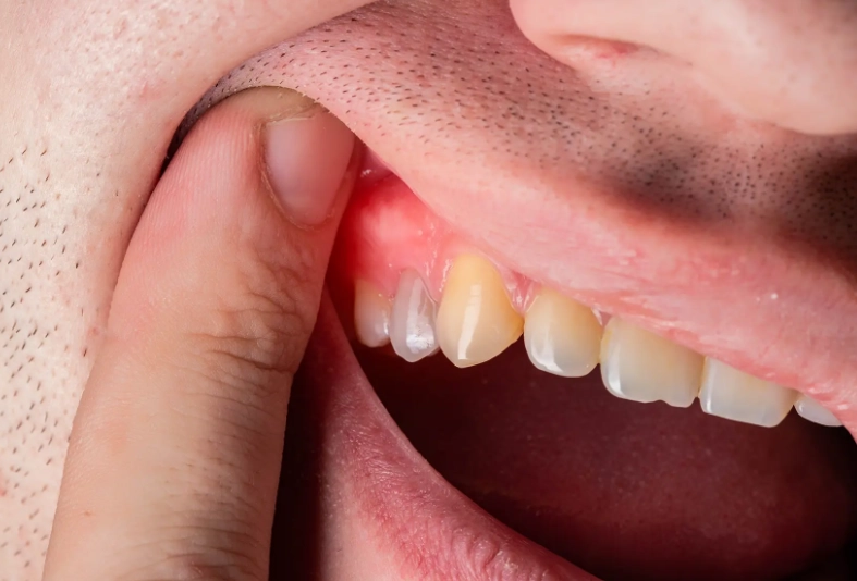 tooth infection home remedy