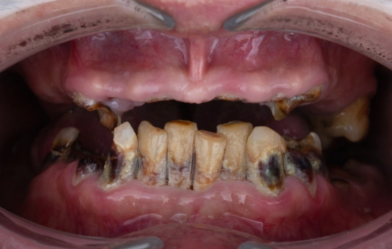 salt water rinse benefits