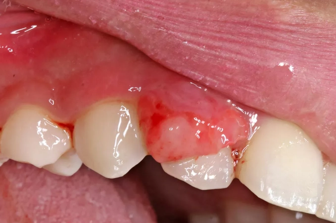 What Do Cancerous Gum Lesions Look Like? Visual Guide & Warning Signs