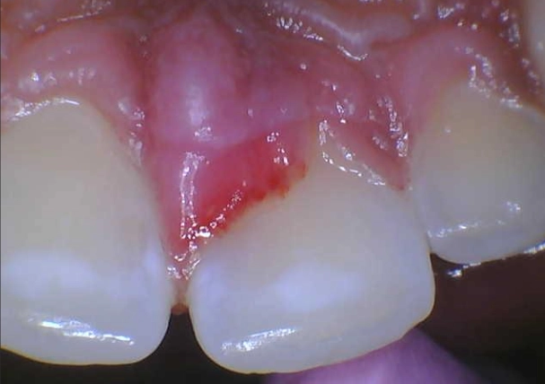 gum inflammation gum inflammation