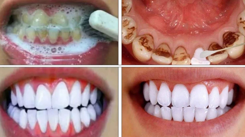 5-Minute Teeth Whitening Hacks: Quick & Safe Methods That Actually Work