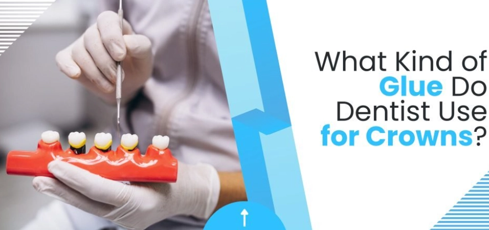 What Glue to Use for a Tooth Crown? The Complete Guide