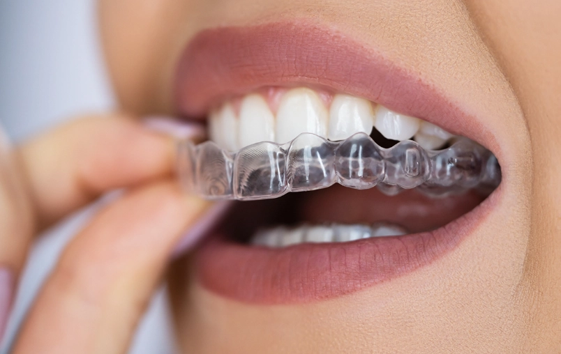 How Long Do Retainers Last After Braces? The Ultimate Guide