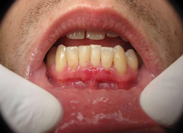 cancerous gum lesions cancerous gum lesions