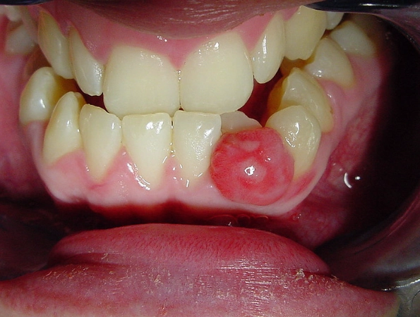 leukoplakia gums leukoplakia gums
