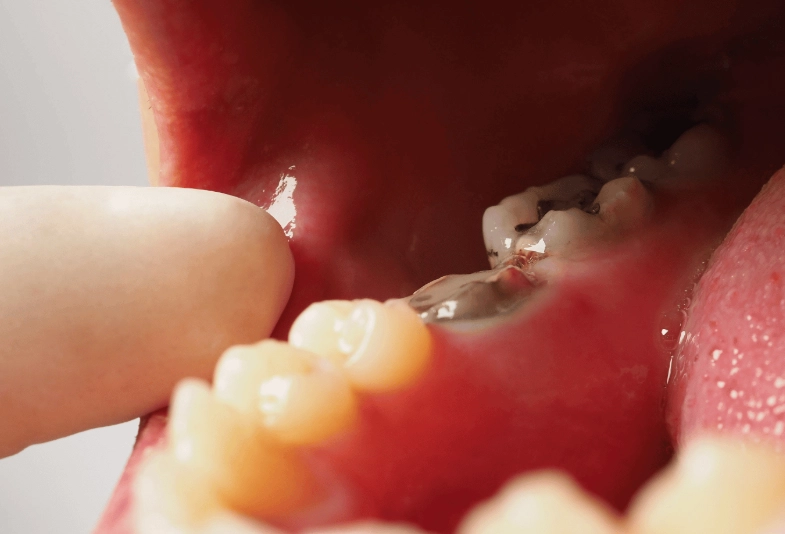 Salt Water Rinse for Tooth Infection: Does It Really Draw Out Infection?
