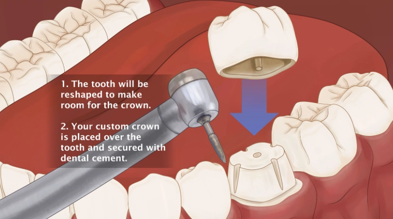 tooth crown glue tooth crown glue