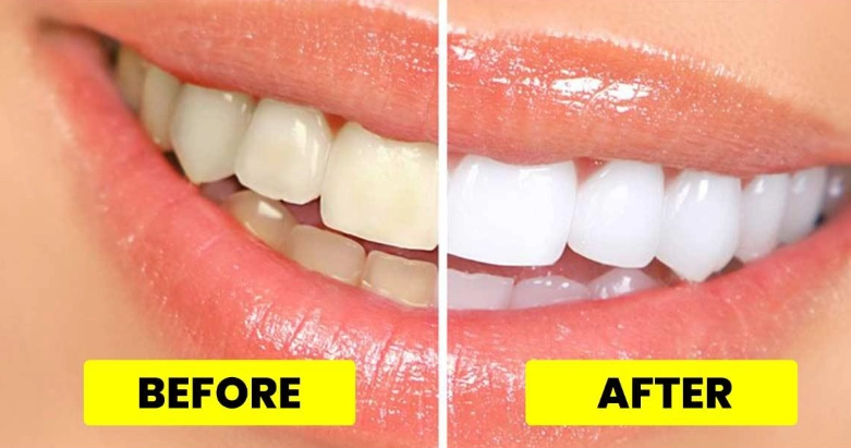 teeth whitening at home fast