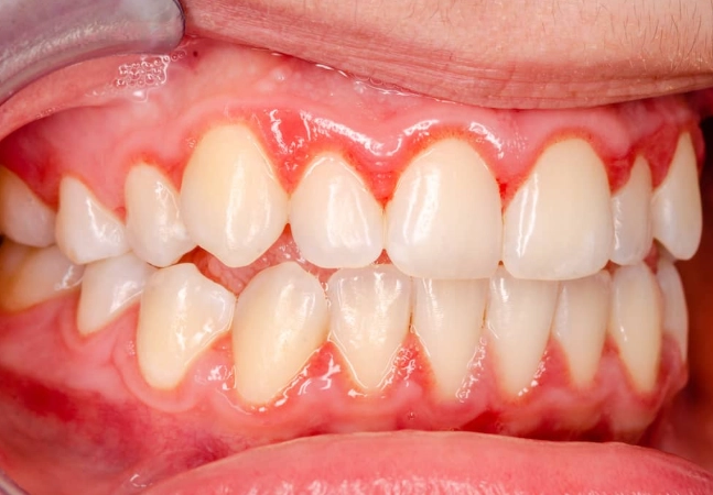 Red Spots on Gums Near Tooth: Causes & When to Worry