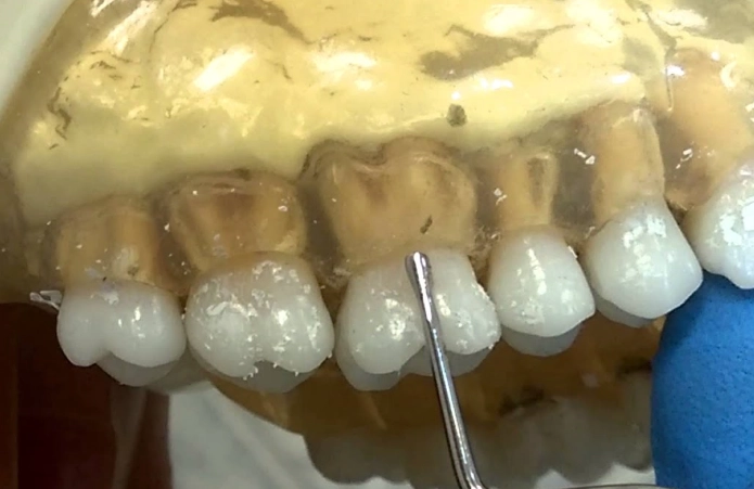 enamel contouring procedure