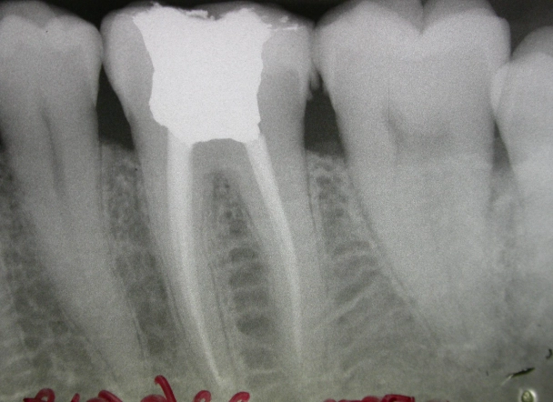molar tooth pain