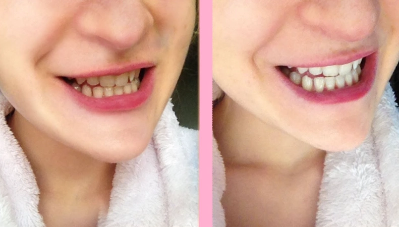 at-home teeth whitening