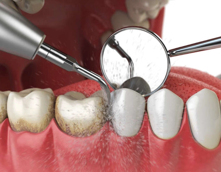 how long does deep cleaning take