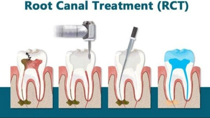 root canal on molar