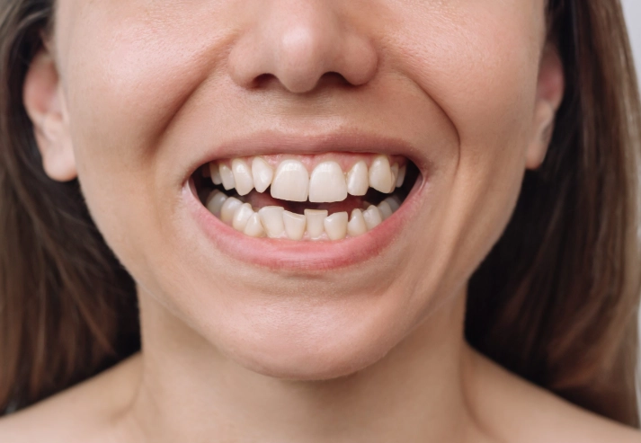 worst foods for teeth