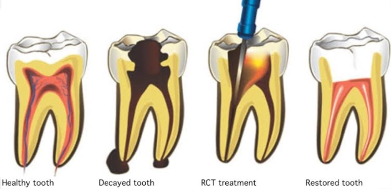 RCT Molar Teeth: The Complete Guide to Saving Your Back Teeth