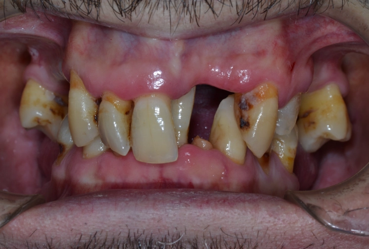 what destroys teeth the most