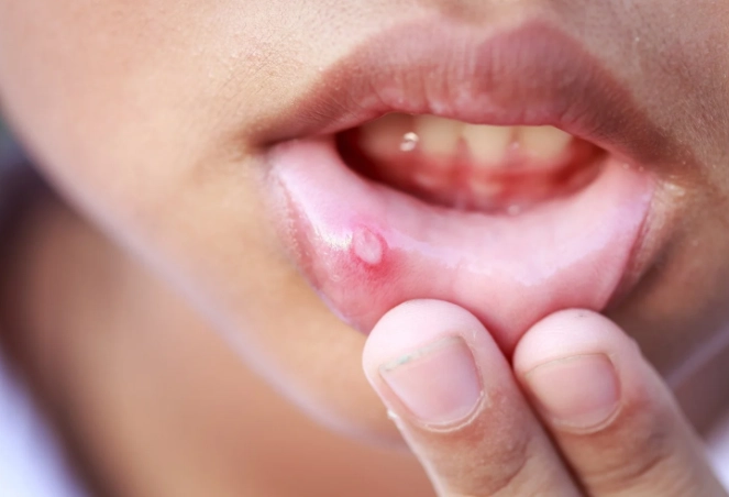 canker sores causes canker sores causes