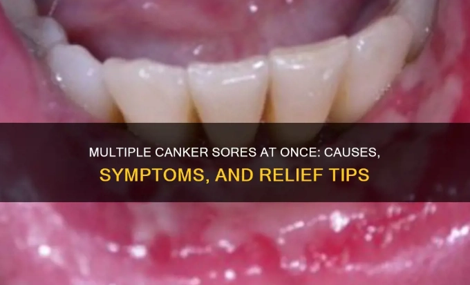 recurrent canker sores recurrent canker sores