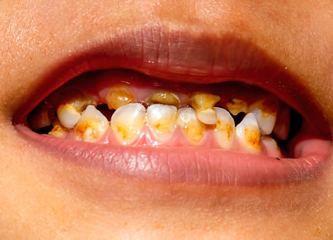 Milk Rot on Teeth: What It Looks Like & How to Stop It
