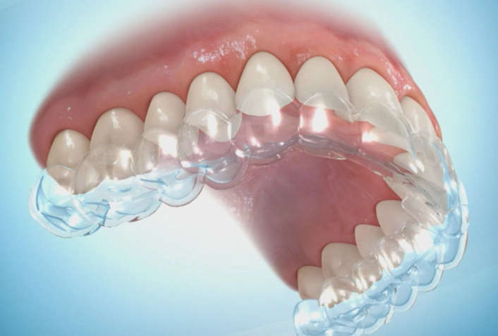 how long do retainers last invisalign