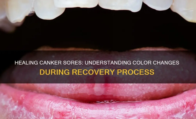 how to get rid of canker sores how to get rid of canker sores