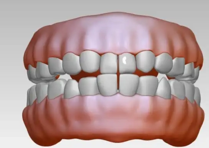 Dental abscess x ray