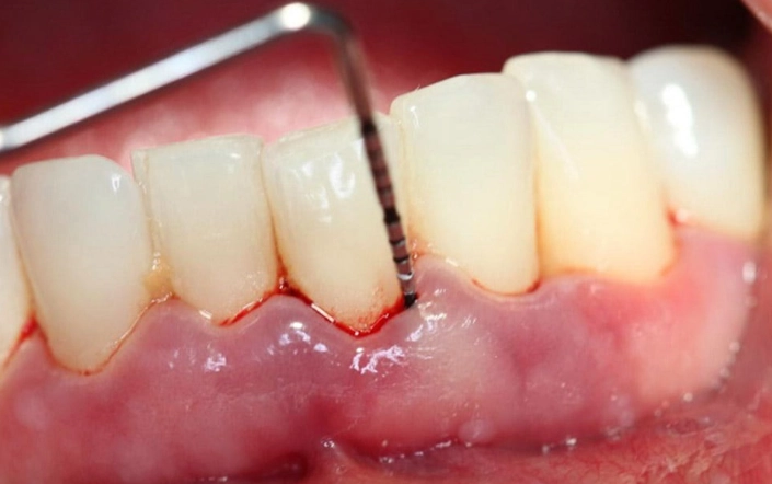 scaling and root planing risks scaling and root planing risks