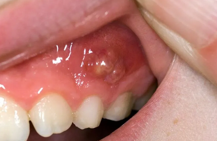 root canal for abscess root canal for abscess