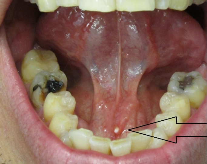 tonsil stones removal