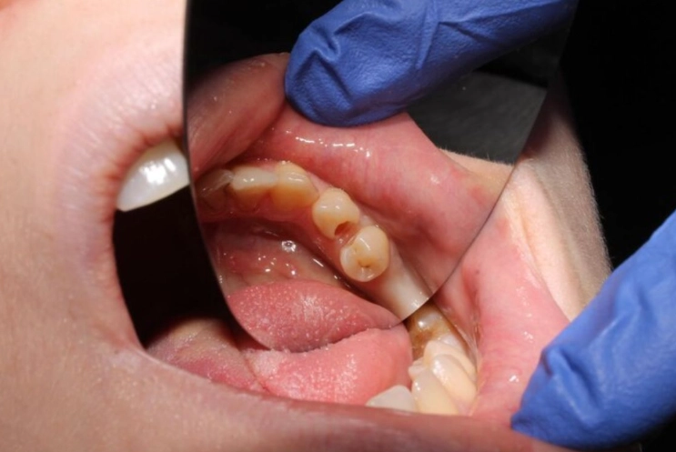 tooth abscess home remedy tooth abscess home remedy