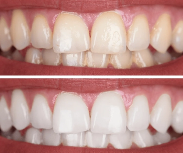 Disadvantages of Deep Cleaning Teeth: Risks, Side Effects & Alternatives