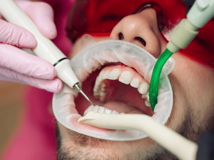 scaling and root planing risks scaling and root planing risks