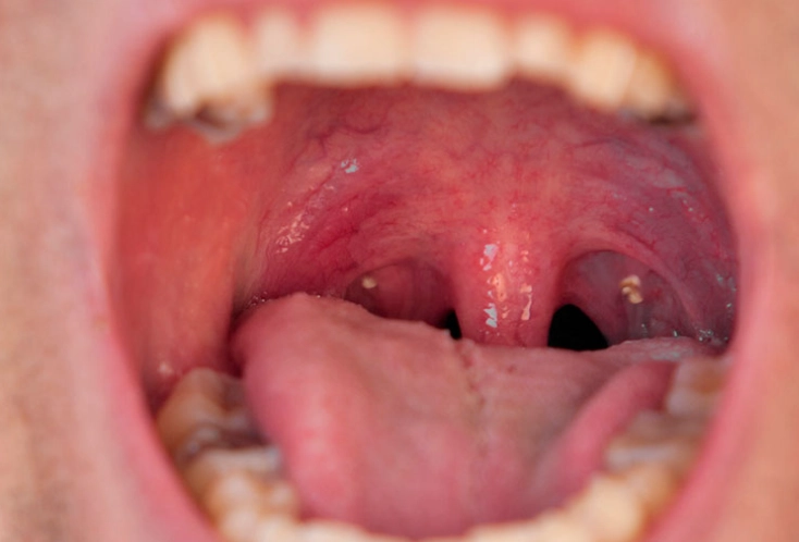 what are tonsil stones