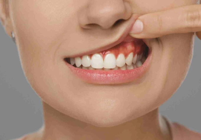 gum abscess gum abscess