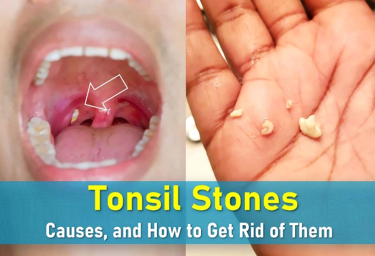 tonsil stones symptoms