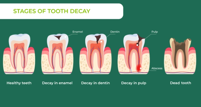 how to stop tooth cavity pain how to stop tooth cavity pain